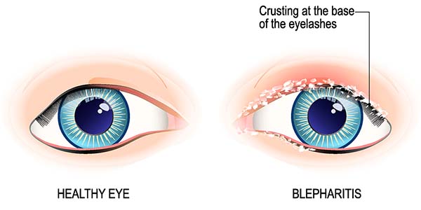 How to Avoid Blepharitis When Getting Lash extensions