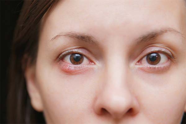 Can Eyelash Extension Cause Blepharitis