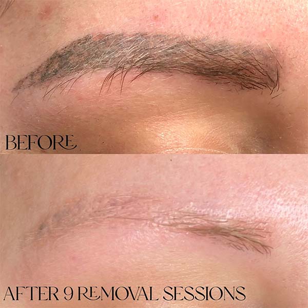 Eyebrow tattoo removal aftercare​