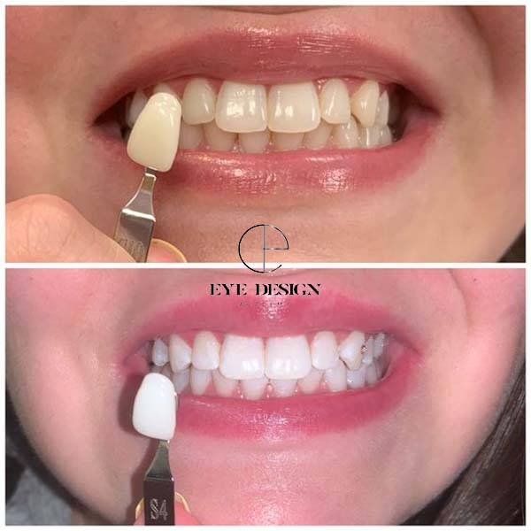 benefits of teeth whitening - teeth whitening at home