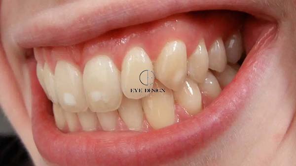 Benefits of Professional Teeth Whitening professionally