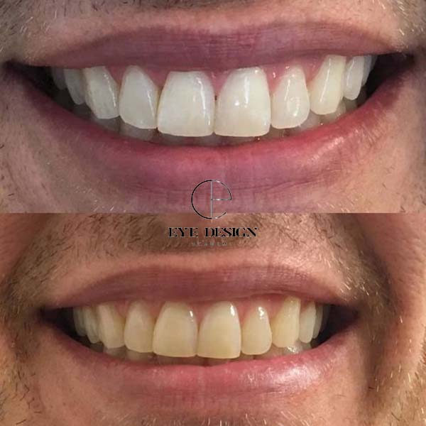 step by step how to use teeth whitening strips