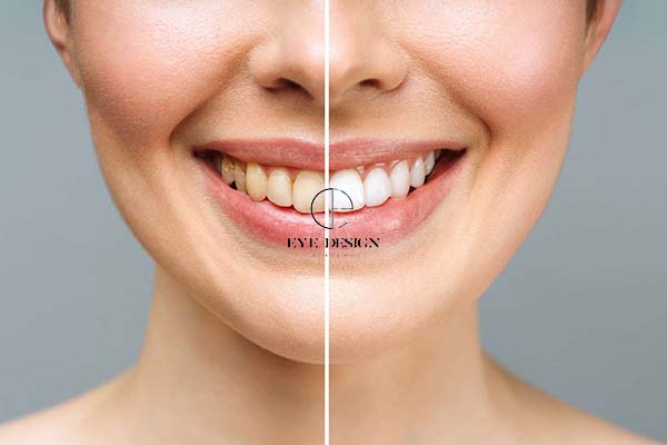 how to use teeth whitening strips step by step