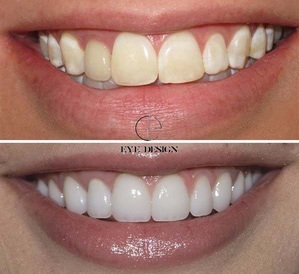 teeth laser whitening