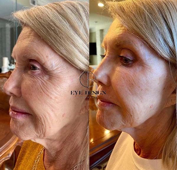 full face fibroblast before and after
