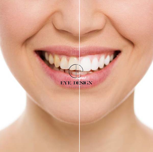 teeth whitening gel